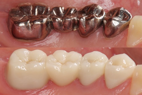 歯科での金属アレルギーの治療