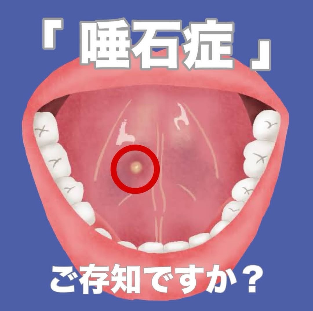 唾石症』について】 – やまぐち歯科|岸和田・貝塚・泉佐野の歯医者・小児歯科・歯周病