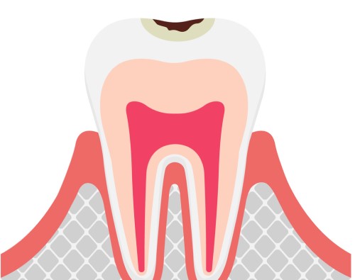 虫歯の治療は早期発見・早期治療が大切